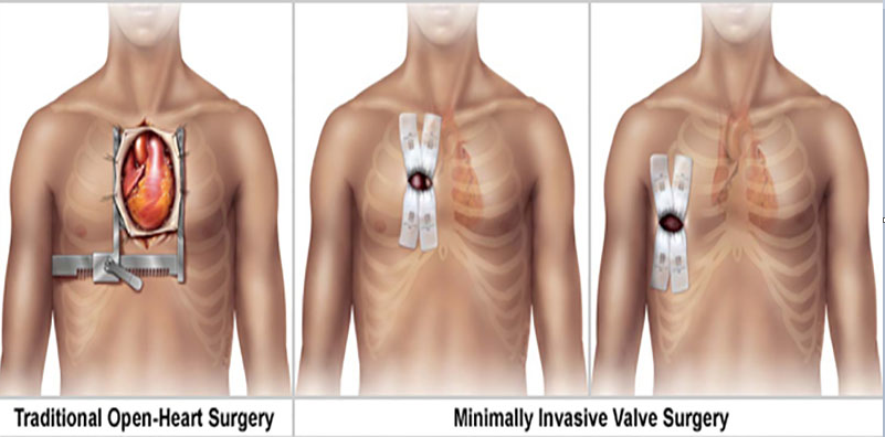 Taux de réussite de la chirurgie de remplacement de la valve aortique